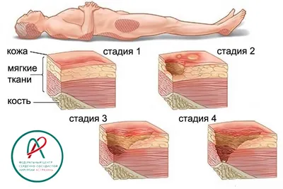 Пролежни.