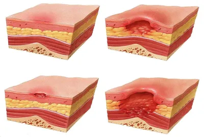 Пролежни – лечение и профилактика