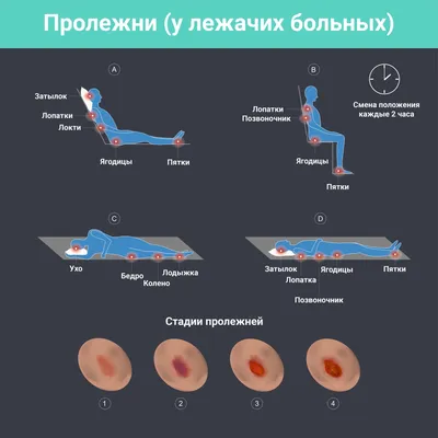 Пролежни: профилактика, уход и лечение