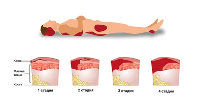Пролежни у лежачих больных, лечение болезни у пожилых людей в Ставрополе