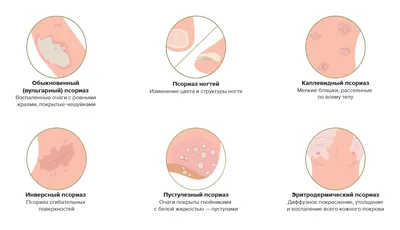 Симптомы и лечение псориаза. Что такое псориаз и кто к нему  предрасположен?: Уход за собой: Забота о себе: Lenta.ru