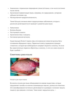 Рак языка — клиника «Добробут»