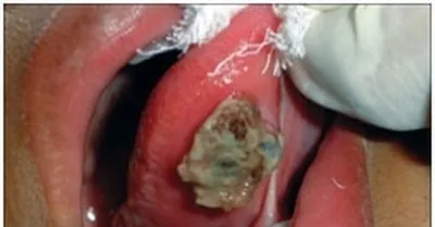Первые признаки рака полости рта, рака губы и языка | Здоровый Гродно