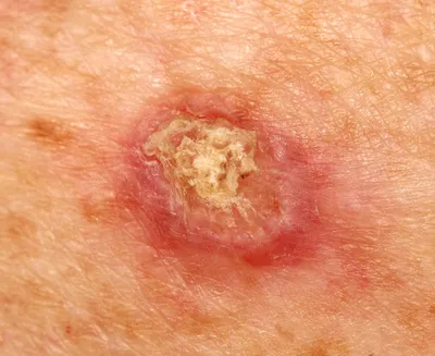 Немеланомный рак кожи: диагностика и лечение