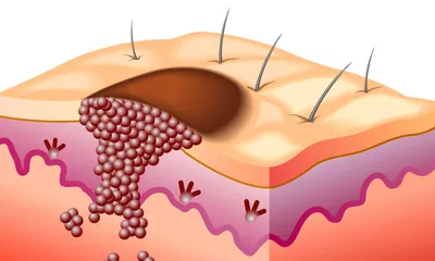 Рак кожи в людях стоковое фото. изображение насчитывающей меланома -  115718128