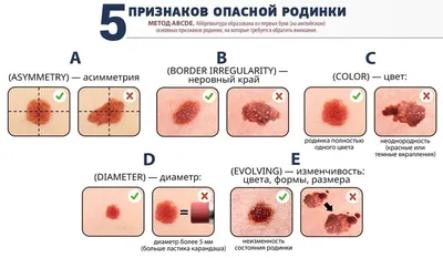 Молекулы жиров в клетках помогут диагностировать рак кожи с 95%-точностью