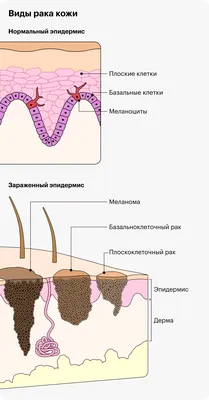 Рак кожи