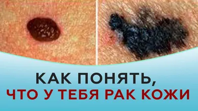Dr. Petrochenko Nikolay - Плоскоклеточный рак кожи… От трех слов уже  бросает в дрожь, 🤭но аккаунт создан для того, чтобы вы могли не только  найти ответы на свои вопросы касаемо онкодерматологии, но
