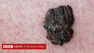 Искусственный интеллект опознает рак кожи не хуже онколога - BBC News  Русская служба