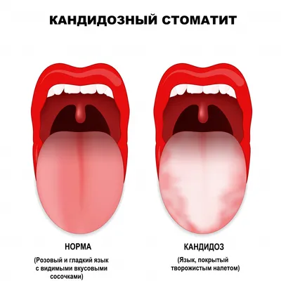 Рак языка и полости рта: причины, симптомы и лечение в статье онколога Опря  А. Н.
