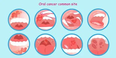 Онколог перечислил симптомы рака полости рта
