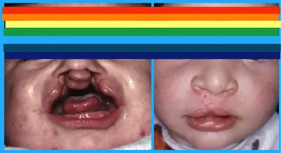 Фиброма полости рта: лечение, признаки, диагностика и типы