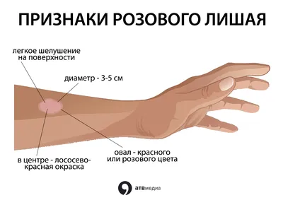 Розовый лишай Жибера: симптомы, диагностика и лечение в клинике Universum  Clinic