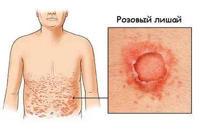 kiddydoc2019 - Розовый лишай (лишай Жибера, pityriasis... | Facebook