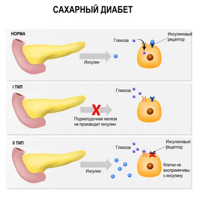 САХАРНЫЙ ДИАБЕТ