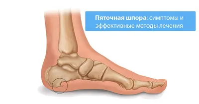 Лечение и удаление мозолей на ногах | Подолог в Алматы