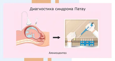 Синдром Эдвардса - online presentation