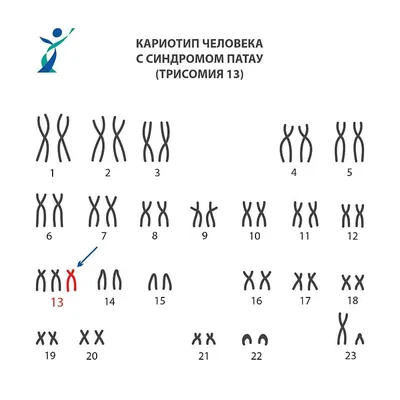 Синдром Эдвардса? при хорошем УЗИ 1 скрининга. — 17 ответов | форум Babyblog