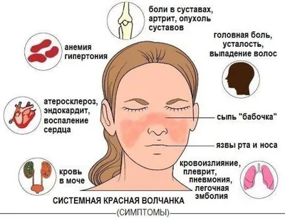 Системная красная волчанка - когда заподозрить и как обследоваться |  Григорий Нефедов | Дзен