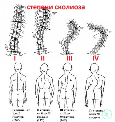 Сколиоз - лечение, симптомы, диагностика, причины, коррекция спины