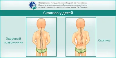 Как определить сколиоз: признаки сколиоза у взрослых и детей