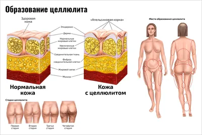 Целлюлит | Как избавиться, что такое и от чего появляется