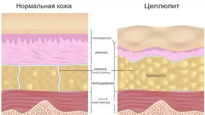 ЦЕЛЛЮЛИТ 🍊 О ПОЗДНЕМ | ВКонтакте