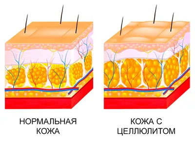 Стадии и виды целлюлита, эффективные методы лечения