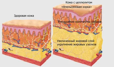 ЦЕЛЛЮЛИТ 🍊 НАЧАЛО | ВКонтакте