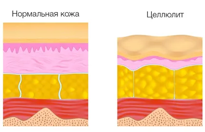 Целлюлит - Русский врач на Майорке Dra Natalya Nagorskikh