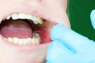 Стоматит: длительность, лечение, диагностика — Ответ пациентам в  стоматологии «Лаки Смаил»