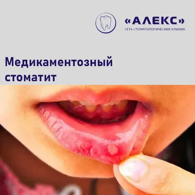 Стоматит полости рта, причины, типы стоматитов – Профилактика, лечение, фото