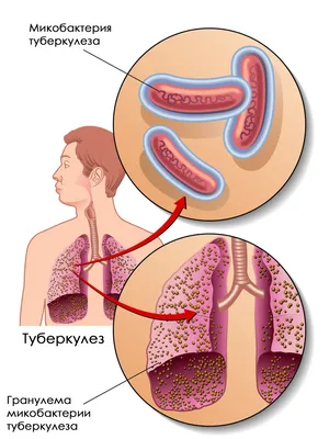 Туберкулез является чрезвычайно распространенной инфекционной болезнью |  Национальный портал “Адырна”