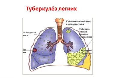 Туберкулёз не щадит ни один орган человека