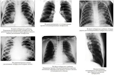 Туберкулез – когда заподозрить у себя?