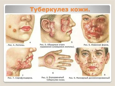 Туберкулез кожи картинки фотографии
