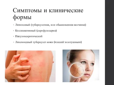 Туберкулез кожи: фото, причины, симптомы, диагностика и лечение
