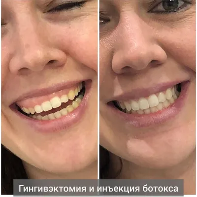 Голливудская улыбка с помощью виниров: цена в Москве | Стоматология  ПРОПРИКУС