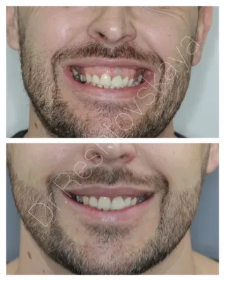 Красивая улыбка и ровные зубы после лечения брекетами.