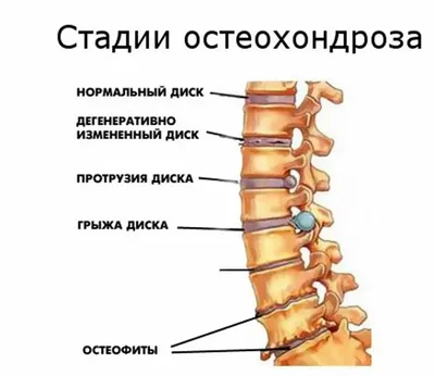 Скидка 50%! Лечение остеохондроза шейного или поясничного отдела  позвоночника. во Владимире на СКИДКОМ.РФ