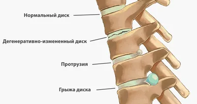 Защемление седалищного нерва (Ишиалгия) - Vertebra