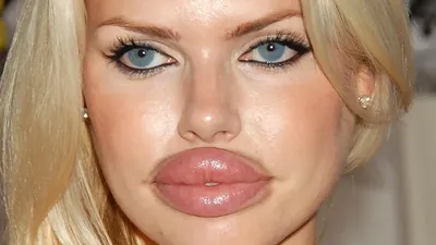 Lips beautification | Контурная пластика губ 💥Увеличение губ со скидкой до  50%! Сделайте свои губы еще более соблазнительными и… | Instagram