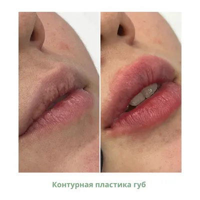 Увеличение губ в Москве: цены, фото до и после, отзывы | Стоимость увеличения  губ в клинике Seline