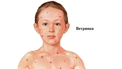 Ветрянка у взрослых | Мама Мальчиков | Дзен