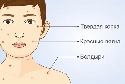 Ветрянка у детей и взрослых | как передается, симптомы, причины, признаки,  диагностика и лечение ветряной оспы