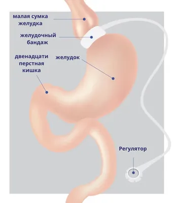 Язвенная болезнь желудка и двенадцатиперстной кишки