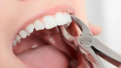 Коронка на зуб — плюсы и минусы по видам, описание, стоимость