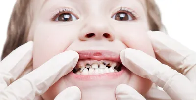 Мертвый зуб: может болеть, лечить или удалять?