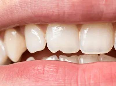 Статья о стоматологии: Лечение молочных зубов