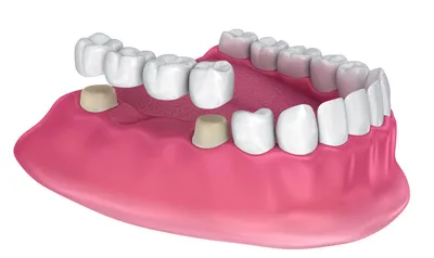 Что делать, если откололся кусочек зуба? Стоматология Ликс Дент
